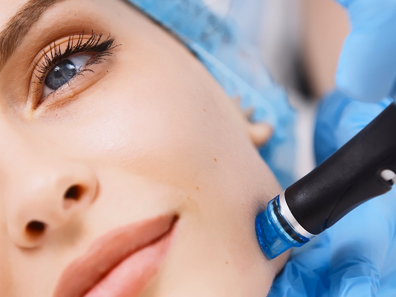 Patientin während einer Hautbehandlung mit einem mikrodermabrasions Gerät, Fokus auf das Gesicht.